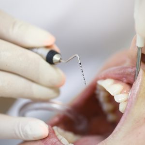Formation parodontologie débutant non chirurgical Barcelone